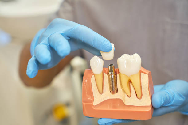 Carillas dentales sobre maqueta