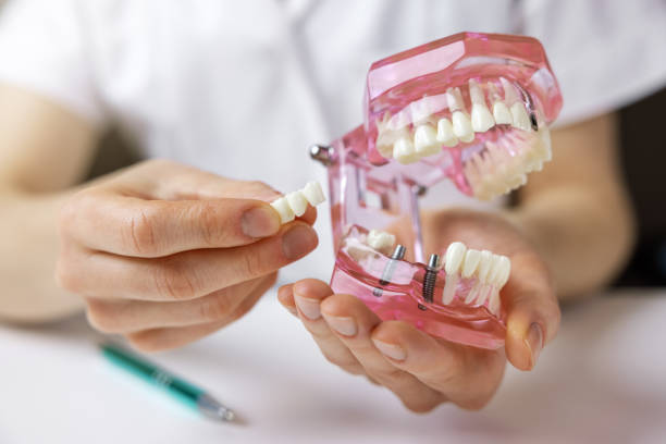Detalle de un implante dental sobre maqueta