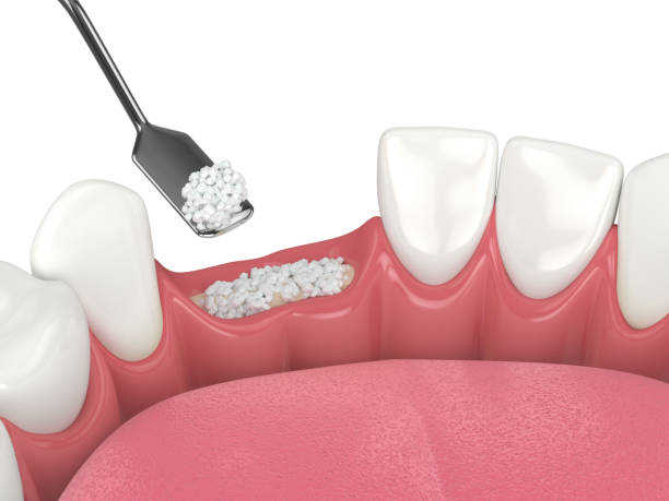 Alineadores transparentes sobre maqueta dental